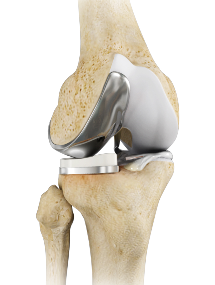 Unicondylar Knee Replacement Partial Knee Replacement