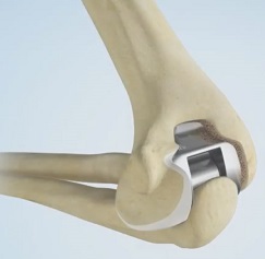 Elbow Joint Replacement Surgery Atlanta | Elbow Arthroscopy Stockbridge GA